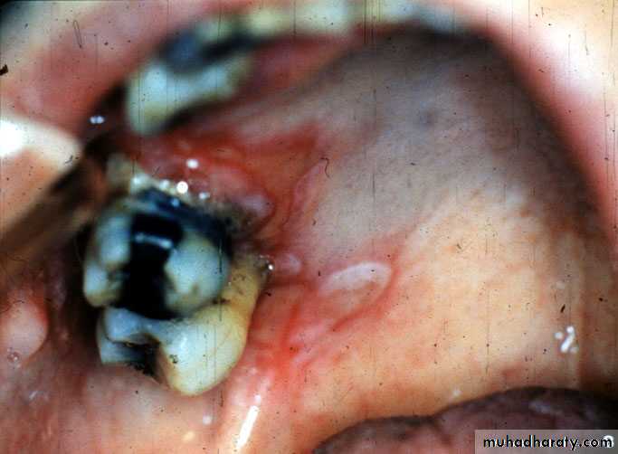 Ulcerated vesicular