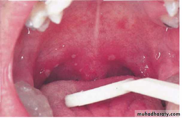 Ulcerated vesicular