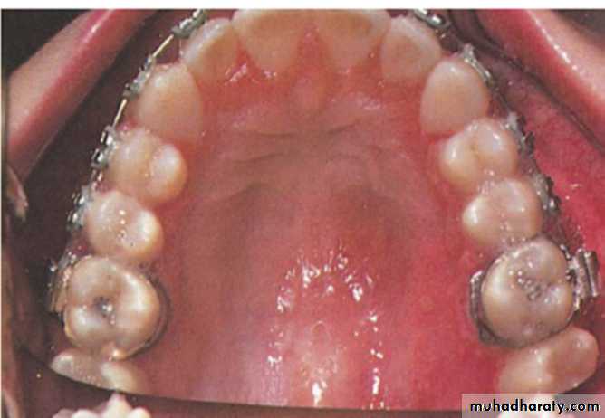 Ulcerated vesicular