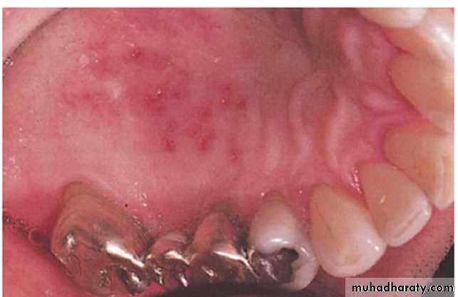 Ulcerated vesicular