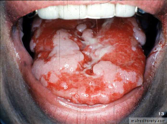 Ulcerated vesicular