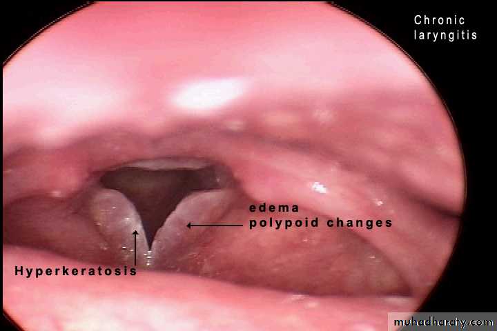 larynx