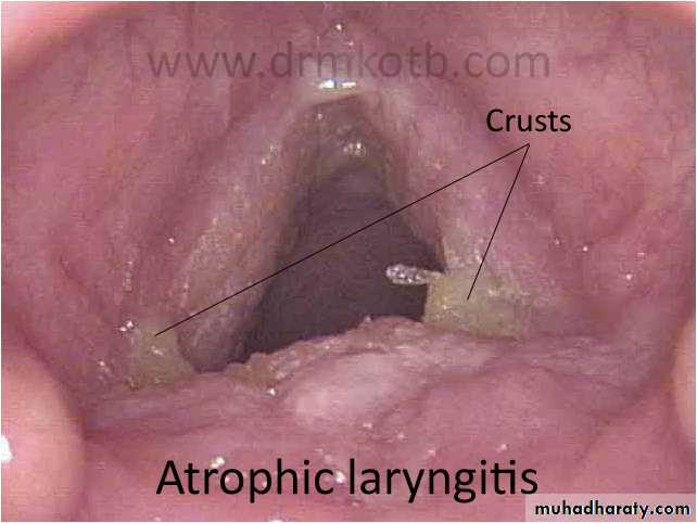 larynx