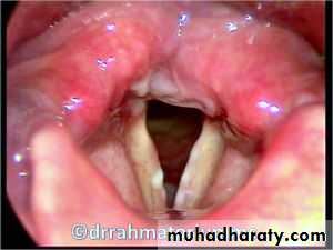 larynx