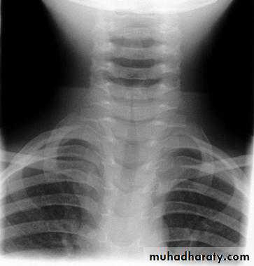 larynx