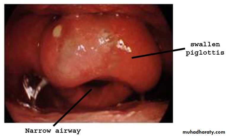 larynx