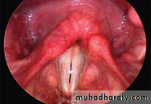 larynx