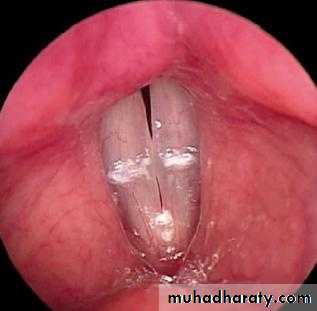 larynx