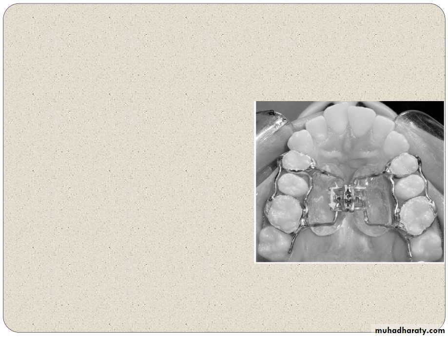 Expansion in orthodontics