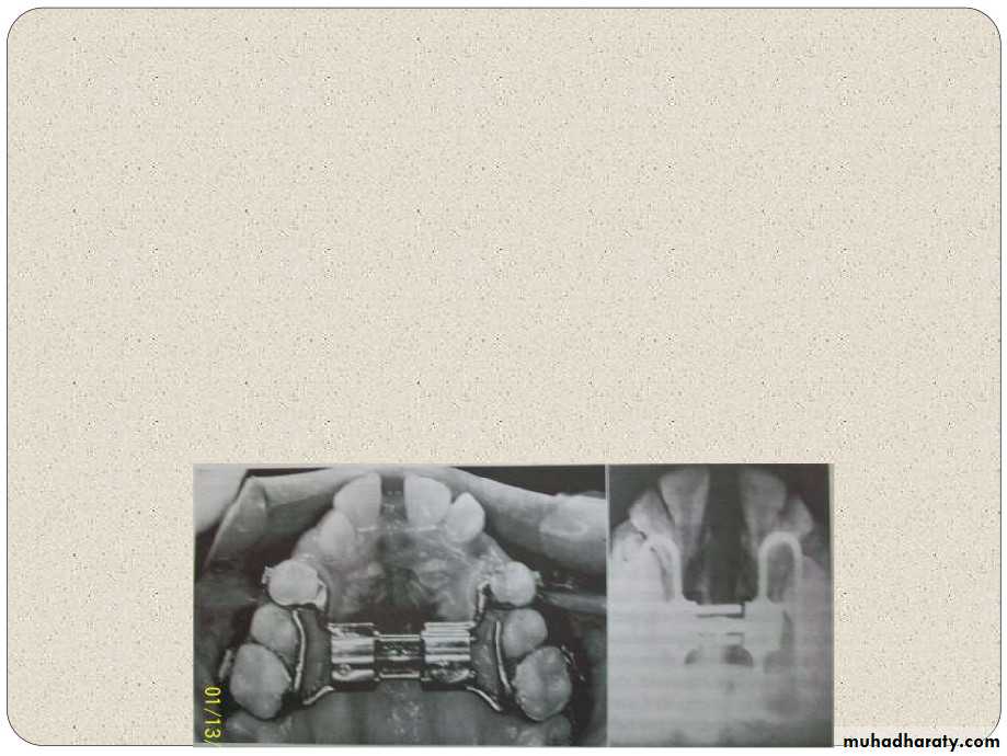 Expansion in orthodontics
