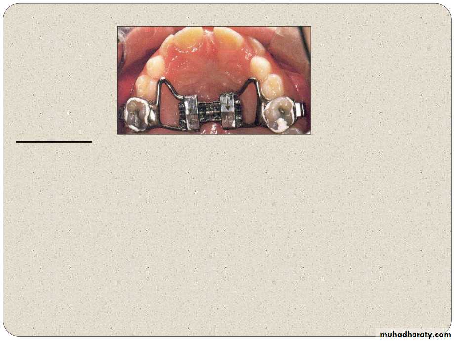 Expansion in orthodontics