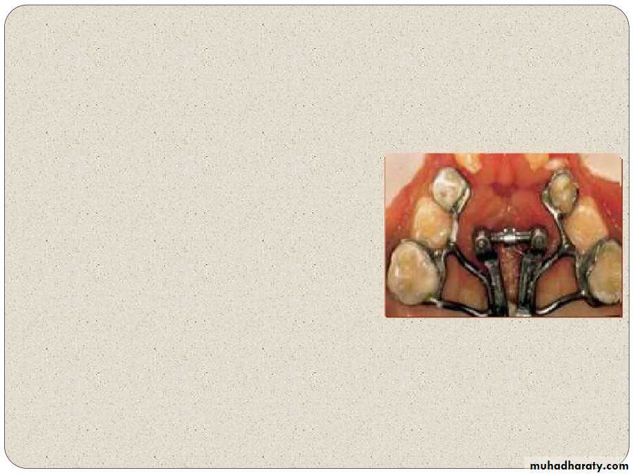 Expansion in orthodontics