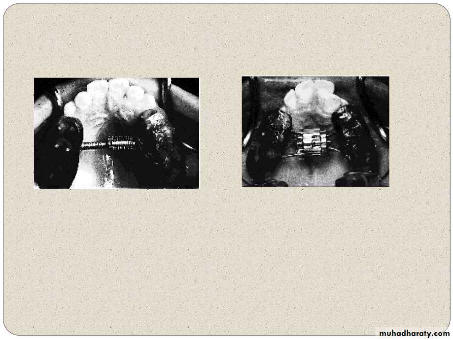 Expansion in orthodontics