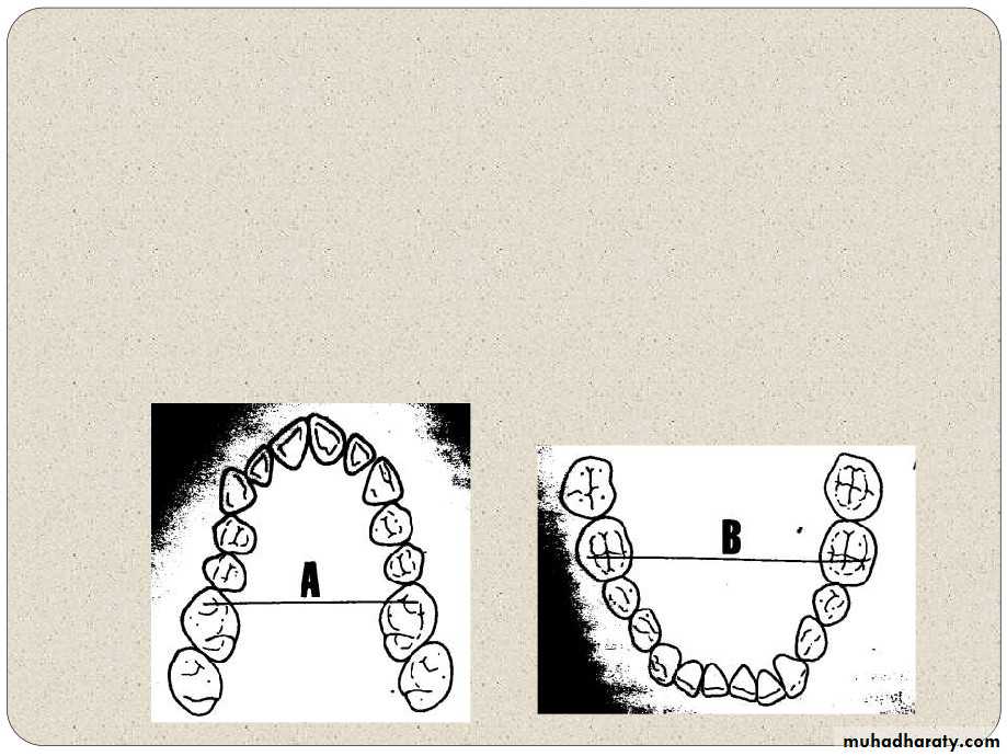Expansion in orthodontics