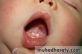 Cleft lip and palate