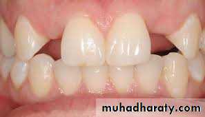 Cleft lip and palate
