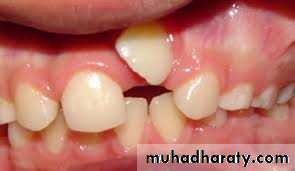 Cleft lip and palate