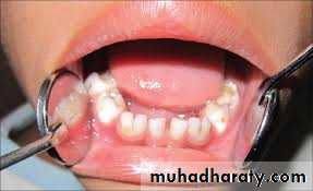Cleft lip and palate