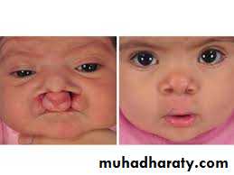 Cleft lip and palate