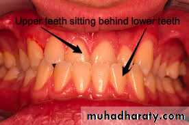 Cleft lip and palate