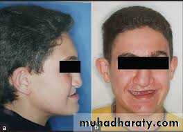 Cleft lip and palate