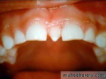 Cleft lip and palate