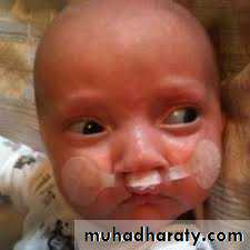 Cleft lip and palate