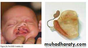 Cleft lip and palate