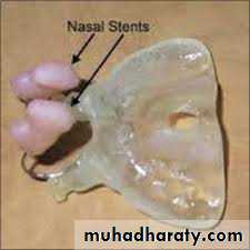 Cleft lip and palate