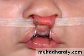 Cleft lip and palate