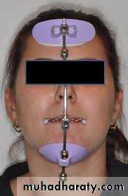 Cleft lip and palate