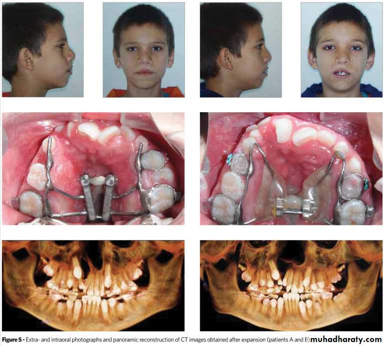 Cleft lip and palate