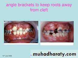 Cleft lip and palate