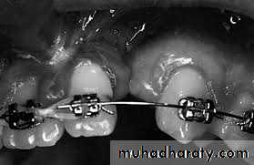 Cleft lip and palate