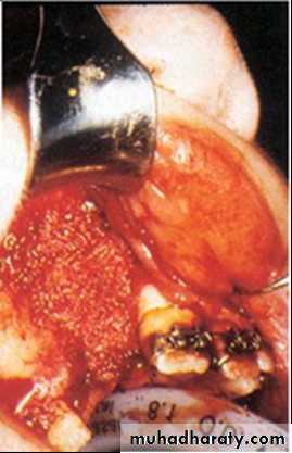 Cleft lip and palate