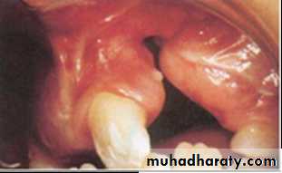 Cleft lip and palate