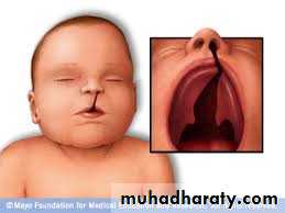Cleft lip and palate