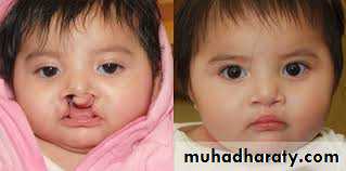 Cleft lip and palate