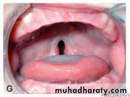 Cleft lip and palate