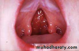 Cleft lip and palate