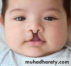 Cleft lip and palate
