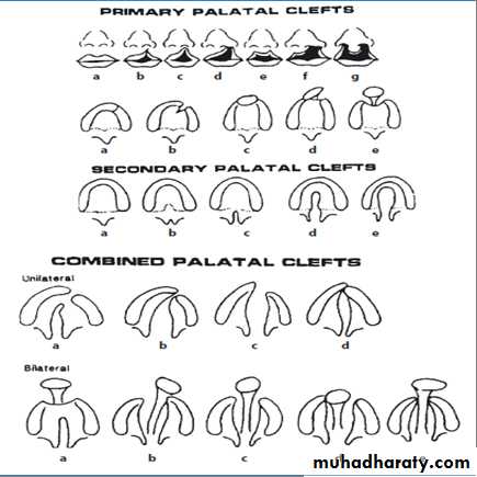 Cleft lip and palate