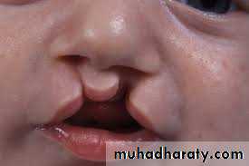 Cleft lip and palate