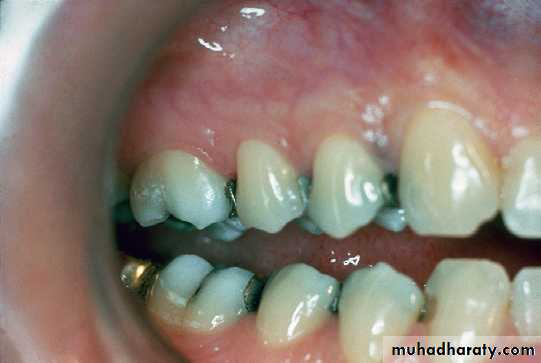 Phase l periodontal therapy