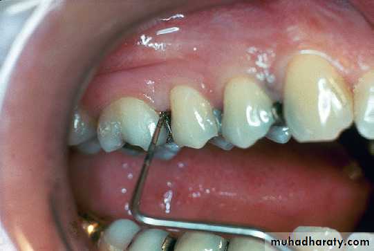 Phase l periodontal therapy