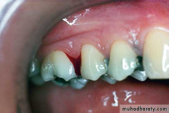 Phase l periodontal therapy