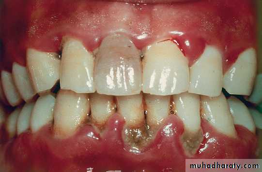 Phase l periodontal therapy