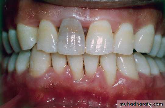 Phase l periodontal therapy