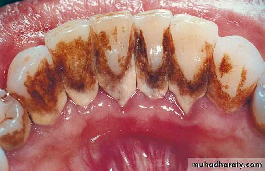 Phase l periodontal therapy