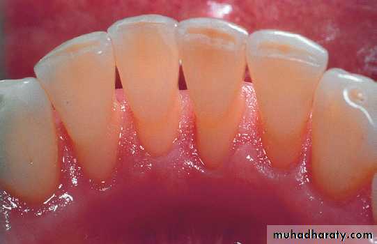 Phase l periodontal therapy